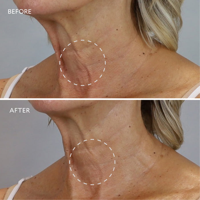 Before and after of neck showing results from Age Benefit Intensive Neck & Decollete Cream
