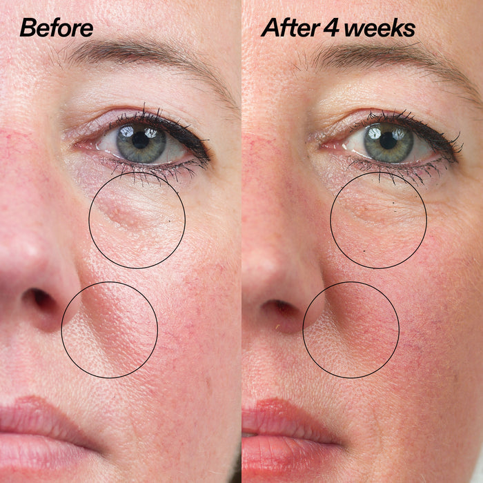 Before and after comparison of a woman's face with circles highlighting areas of improvement.