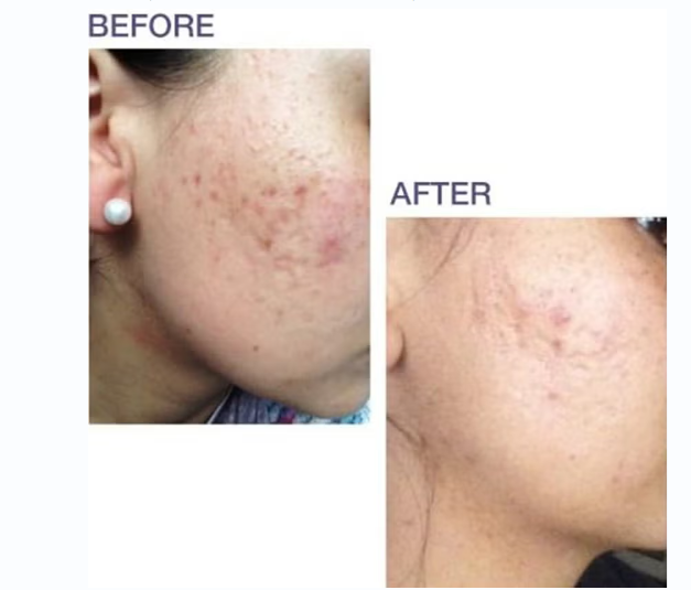 Biodermis Prosil SPF15 Silicone Stick For Scars 4.25g Biodermis