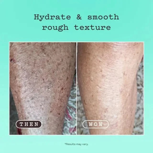 Before and after leg skin comparison on teal background showing Frank Body AHA Body Lotion results, labelled "Then" and "Wow".
