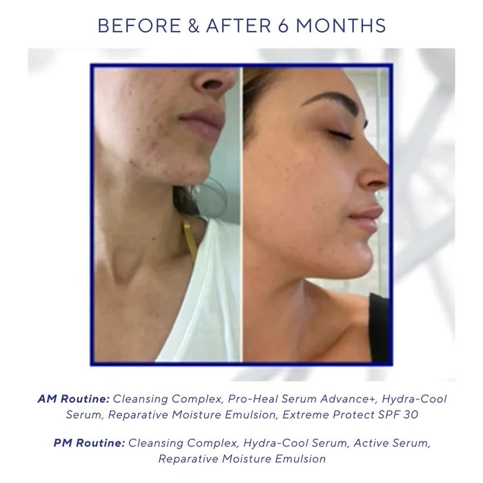 Side-by-side comparison of a woman's lower face before and after six months of skincare routine