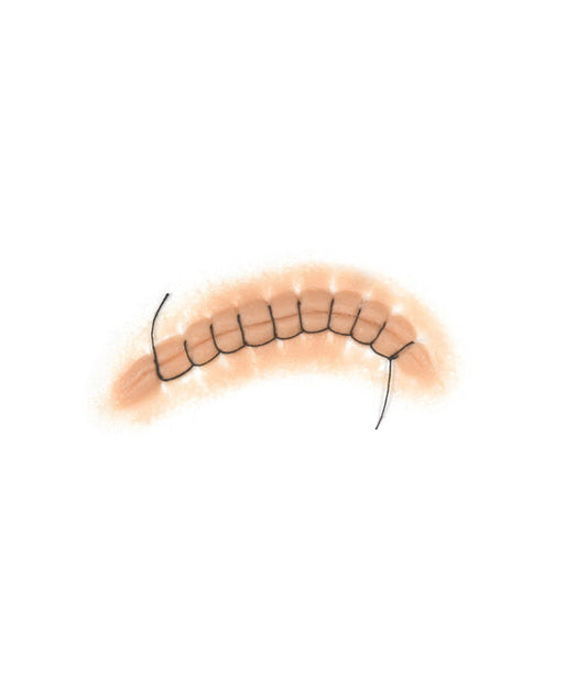 Locking Stitch Suture 1