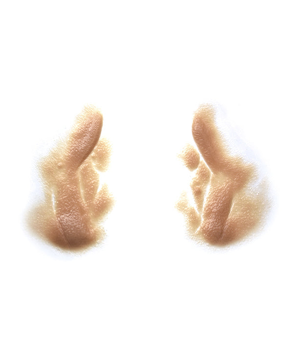 Male Nasolabial Folds and Jowls 3