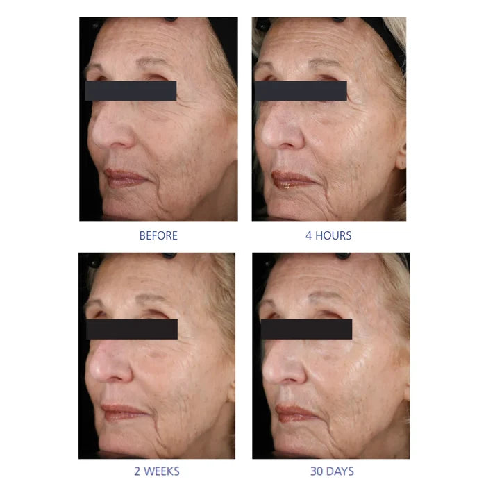 Four close-up side profile images of a woman’s eye area showing skin changes over time labelled before, 4 hours, 2 weeks, and 30 days